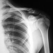 shoulder xray small